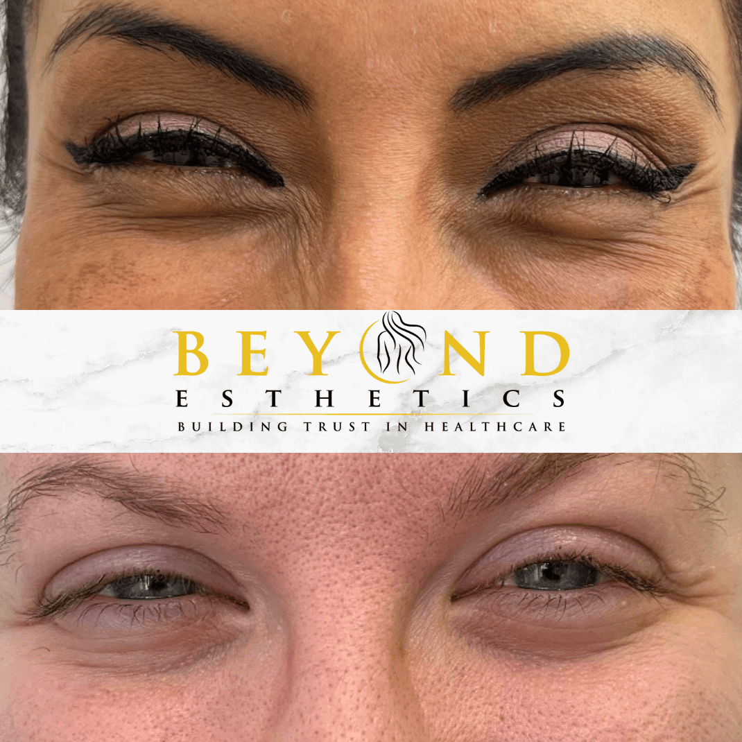 How Many Units of Botox for Cr